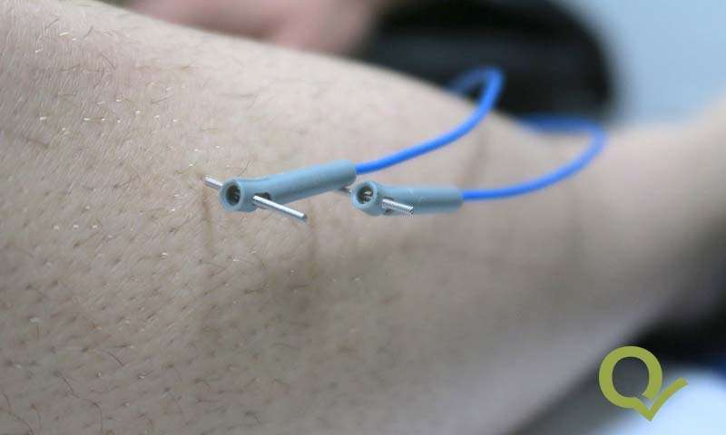 qualife electro acupuntura cartagena